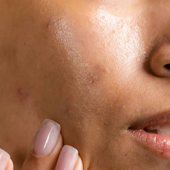 Acne & Breakouts